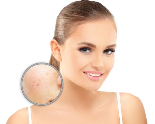 Akne Akne behandeln beim Hautarzt Dr. Shab in Frankfurt