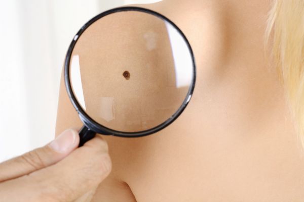 Hautkrebsvorsorge Frankfurt Hautkrebsvorsorge beim Dermatologen in Frankfurt