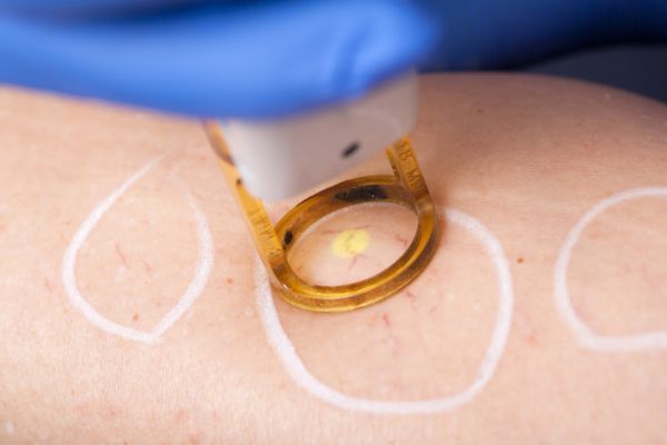 Lasermedizin Laserbehandlung am Bein