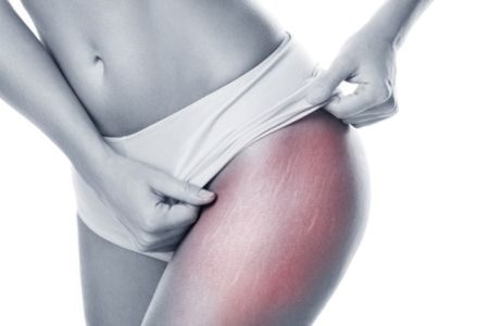 mesotherapie dehnungsstreifen Frau mit Tuch nach Mesotherapie